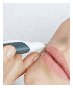 SMART NEEDLE EPILATION